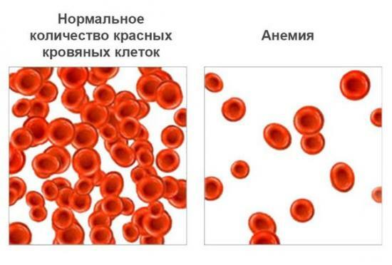 Hemoglobin berkurang, pengobatan untuk orang dewasa, anak-anak, wanita hamil