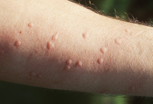 Allergic reactions: what is it, symptoms, causes, treatment