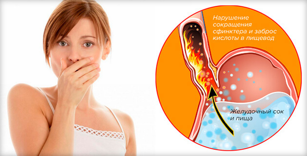 Treatment of heartburn during pregnancy