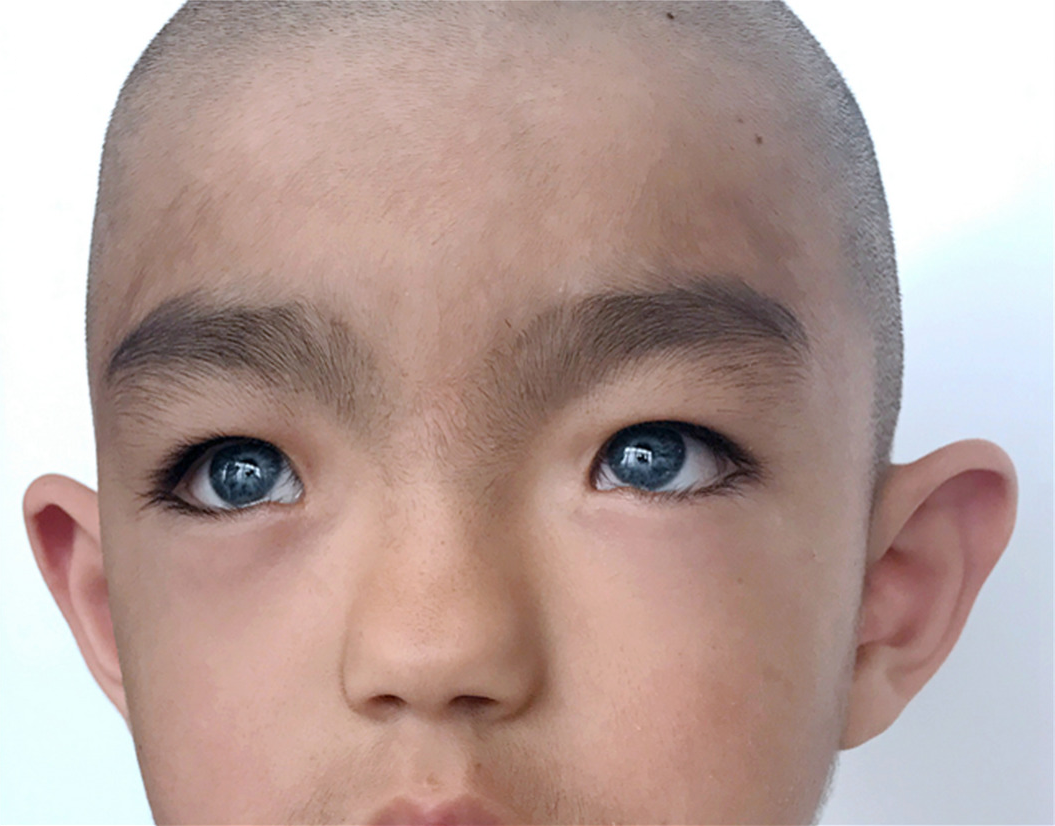 Waardenburgov syndróm: čo to je, príznaky, liečba, prognóza