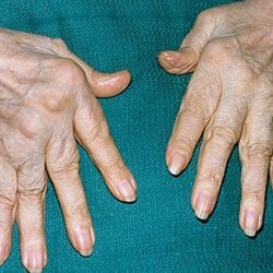 Wat is reumatoïde artritis?