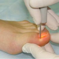 Ingrown toenail: treatment