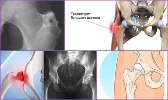 Trocánter de la cadera: síntomas, tratamiento, pronóstico, diagnóstico