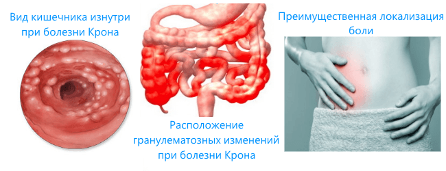 Doença de crohn