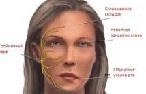 Neuritis pada saraf wajah