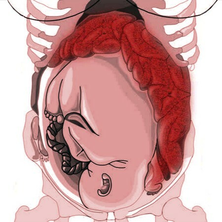 Increased fetal pressure on the intestine