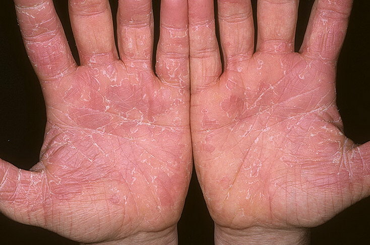 Exfoliative dermatitis: symptoms and treatment