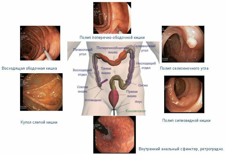 Colonoscopy: the essence of the method, indications and rules of preparation for the procedure
