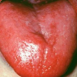 Glossitis: tünetek és kezelés