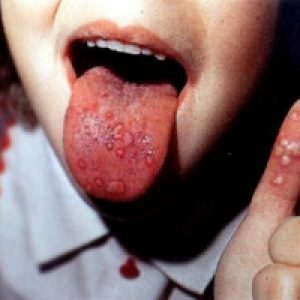 Slintavka a kulhavka u člověka: jak se vyskytuje infekce, příznaky, prevence, léčba