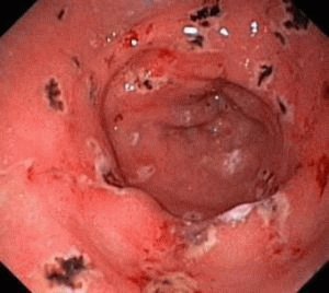 Erosieve gastritis