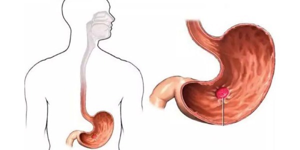 Úlcera de estómago: causas y síntomas de la úlcera de estómago, opciones de tratamiento