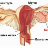 Operative treatment of ovarian cysts