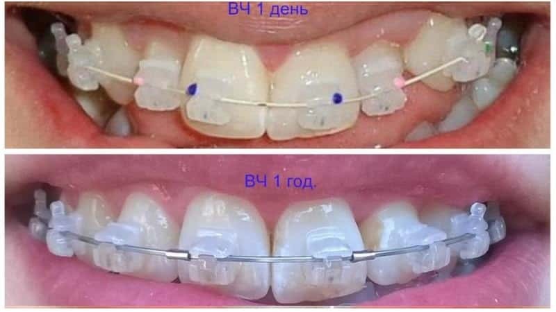Zahnspange - Fotos vor und nach der Ausrichtung von Malokklusion