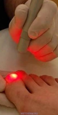 Wie ist die Behandlung des Nagelpilz-Lasers?
