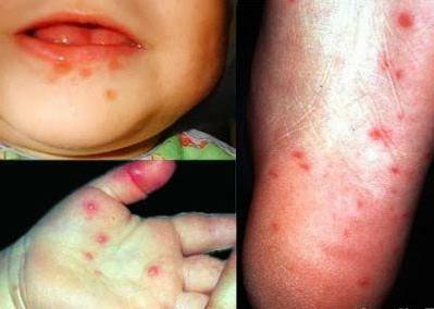 Clinical signs of enterovirus infection