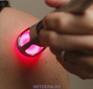 Laser treatment of scars