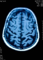 Gliosis verandert in de hersenen