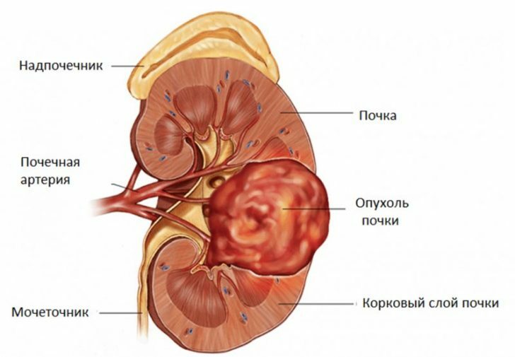 Kidney Cancer: First Symptoms, Stages, Treatment, Forecasts