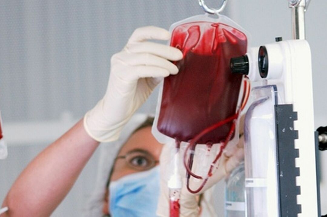 Operation of replacement blood transfusion( OZPK)
