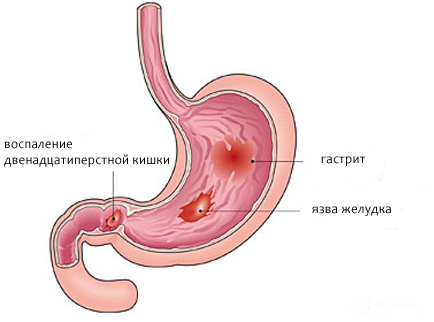 Manifestations of inflammation of the stomach