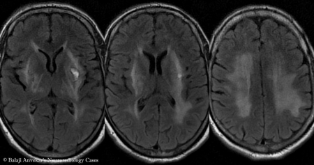 Encefalopatija možganov: simptomi in zdravljenje
