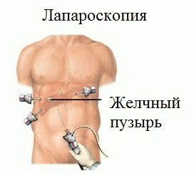 Laparoscopia