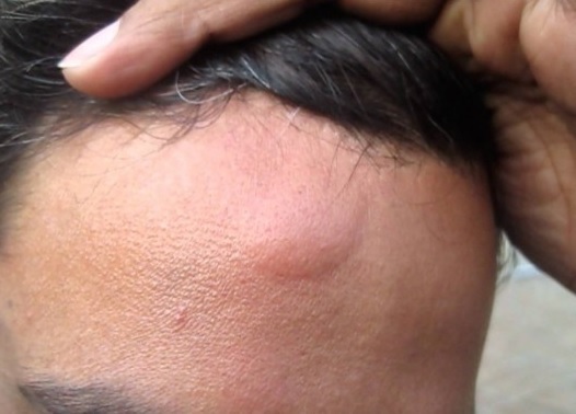 Can a solid lump on the head be dangerous?