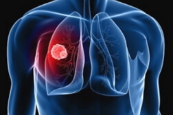 Tuberkuloza pluća