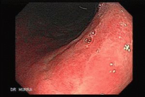 Behandelingsregimes voor gastritis met Helicobacter pylori