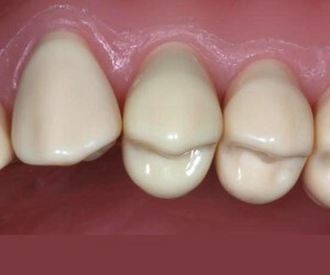 Quelles sont les dents molaires