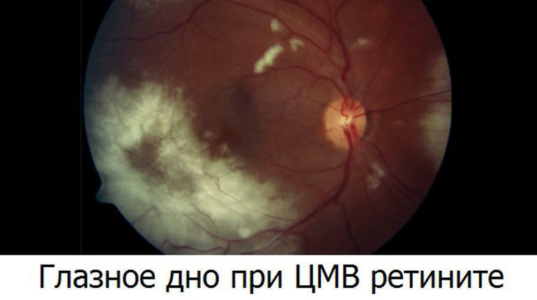 Retinitis-eye