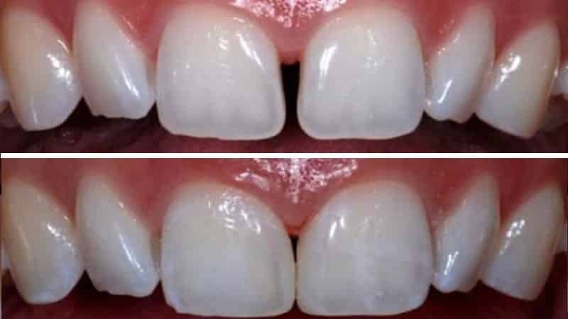 Cómo eliminar el hueco entre los dientes: puede fijar un agujero entre los dientes delanteros