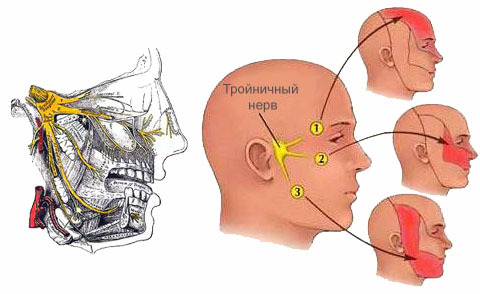 Trigeminusneuralgie - Symptomen, behandeling