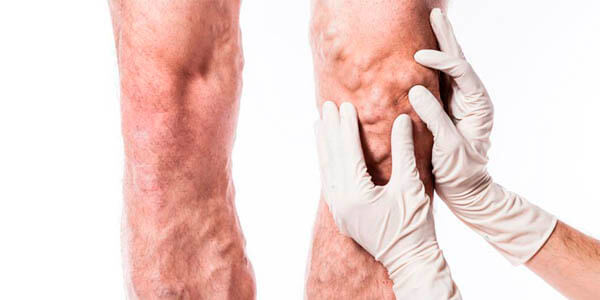 À quoi ressemblent les varices sur les jambes chez les adultes, les symptômes caractéristiques et les caractéristiques permettant de déterminer vous-même la maladie