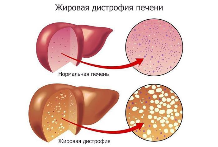 Fígado com degeneração gordurosa