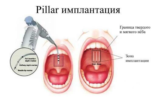 Pillar Implantation