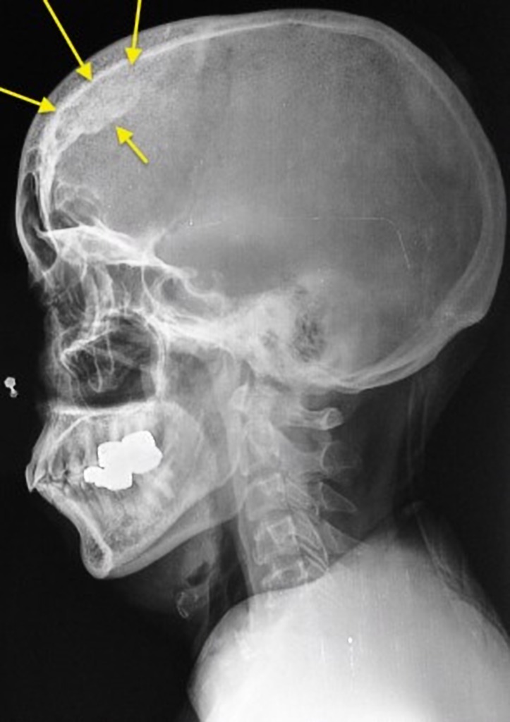 Кость на затылке. Гиперостоз черепа рентген. Костный экзостоз костей черепа. Гиперостоз лобной кости рентген. Гиперостоз костей черепа рентген.
