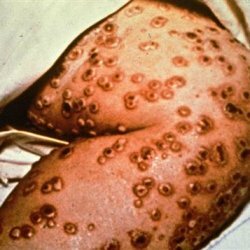 Typhus palavik