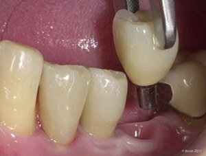Az ára fogászati ​​implantátumok: Mit tartalmaz a szolgáltatás ára és mennyit kell költeni az implantátum