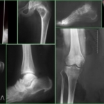 Hyperostose der Knochen - Rengen auf den Beinen