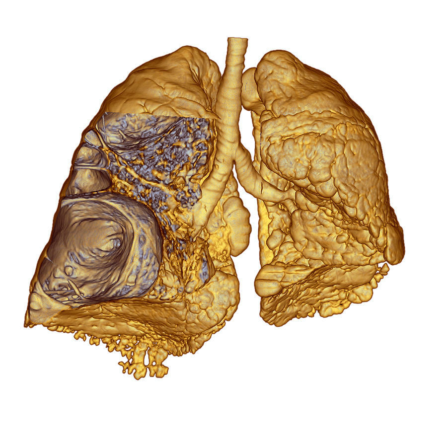 Structural changes in the lungs that occur with emphysema