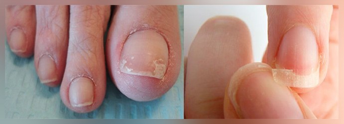 Det inledande skedet av nagelsvamp