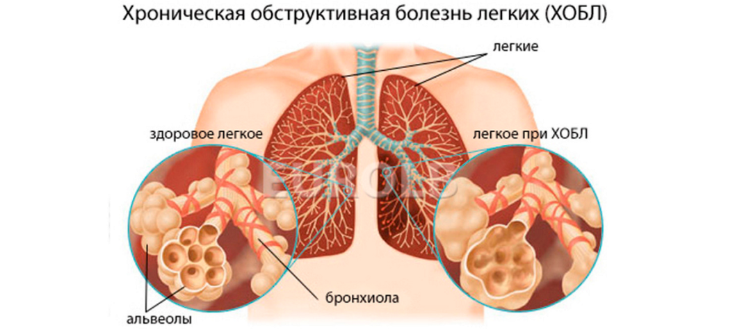 Obstruktív bronchitis: tünetek és kezelés
