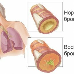 How to get rid of phlegm in the bronchi and lungs