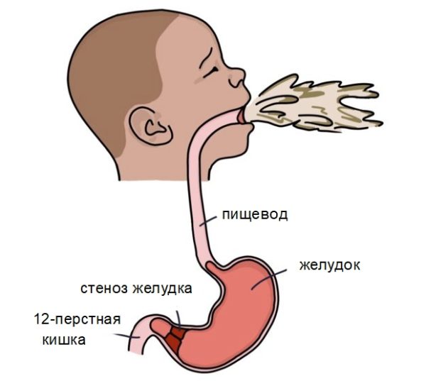 Maagstenose