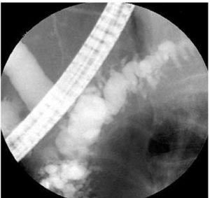 Chronische terugkerende pancreatitis 