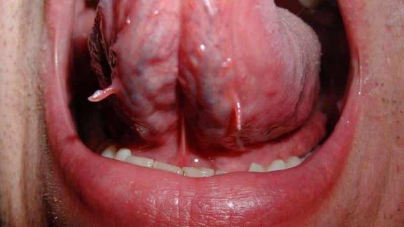 brodawczaka w ustach