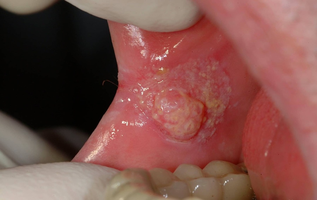 objawy raka jamy ustnej znaki zdjęcie