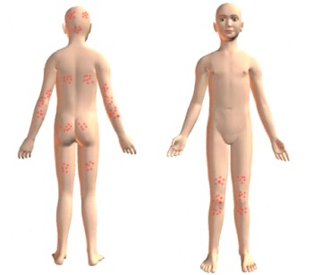 Symptomen van dermatitis Dühring